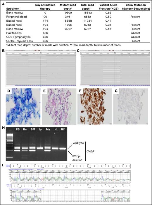 Figure 2. A somatic 52-bp deletion in the CALR gene is detected in buccal epithelial cells. (A) Table summarizing the detection of CALR mutation by NGS and Sanger sequencing in various tissues. (B-C) NGS of diagnostic BM (B) and buccal cells (C) visualized through Integrated Genome Viewer. Sequence reads are aligned to the CALR locus. Gray bars represent read alignments. White gaps in alignment represent areas of deletion. (D) Cytospin preparation of buccal cells stained with Diff-Quick (Romanowski) stain. (E-G) Paraffin-embedded buccal cell block stained with hematoxylin and eosin (E), cytokeratin AE1/AE3 (F), and CD45 (G). Original magnification ×40 in panels D-G. (H) The CALR locus was amplified by polymerase chain reaction in PB, buccal mucosa, BM, CD3-selected PB lymphocytes, CD15-selected PB myeloid cells, and hair follicles from the patient and in a normal tissue control obtained from an unrelated donor. The amplified product was separated by electrophoresis on an agarose gel and stained with ethidium bromide. The wild-type and 52-bp–deleted CALR bands are indicated. (I) Sanger sequencing traces of the wild-type (upper panel) and mutant (lower panel) buccal sample, mapped to the reference CALR sequence. Bu, buccal mucosa; H, hair follicles; Ly, CD3-selected PB lymphocytes; My, CD15-selected PB myeloid cells; NC, normal tissue control.