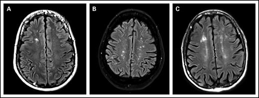 Figure 1. MRI, FLAIR images, axial slices. (A) White matter lesion, type 1: focal lesion. Focal hypersignal on right frontal lobe. (B) White matter lesion, type 2: beginning confluence lesion. Multiple focal hypersignal on right and left hemispheres. (C) Another white matter lesion, type 2: beginning confluence lesion. Multiple hypersignal on right and left hemispheres with small confluence.