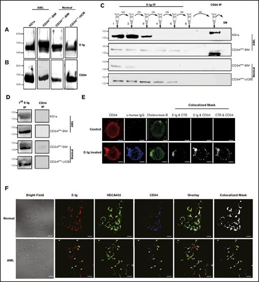 Figure 2. The sialomucin CD34 is a novel ligand for E-selectin. (A) CD34 was immunoprecipitated from HSPC-enriched lysates of CD34pos cells isolated from normal UCB cells (CD34pos-UCB), normal BM cells (CD34pos-BM), AML BM cells (CD34pos-AML), or KG1a cells (n = 3 patient samples and KG1a cells). Lysates were subjected to western blot analysis with E-Ig chimera. This is a representative blot of n = 3 experiments. (B) The reciprocal immunoprecipitation assay was performed where E-Ig chimera was used first for immunoprecipitation prior to western blot analysis using CD34 QBend-10 mAb (n = 3). (C-D) AML cells express a unique form of CD34 that does not function as an E-selL. Multiple rounds of E-Ig immunoprecipitations were performed on both normal and AML sample cell lysates, and following the clearance of E-Ig reactive bands, the residual lysates were immunoprecipitated using QBend-10 (CD34-mAb that recognizes all classes of CD34) and subjected to western blot analysis for CD34 (QBend-10) (C) and anti-sLex (HECA-452) (D). SN = supernatant. For panel D, as described in the supplemental Materials and methods, only the first elution after E-Ig immunoprecipitation and the CD34 immunoprecipitation are shown. These blots are representative of n = 4 separate experiments. (E) KG1a cells were pretreated with E-Ig chimera or left untreated prior to lipid raft staining with choleratoxin-β (CTB)-AF-594 (green). Fixed cells were then stained with CD34 (Cy5; red) and AlexaFluor-488 streptavidin (blue) toward biotinylated anti-human-Ig to detect E-Ig. The colocalized mask was analyzed using Imaris Coloc software. Cell surface labeling with an isotype control or a secondary antibody alone served as background controls (data not shown). Results are representative of n = 3 independent experiments, 7 fields per experiments; >5 cells per field. Scale bar is 5 μm. (F) CD34pos cells from AML BM (lower panels) express a CD34 glycoform that does not bind E-selectin, whereas CD34pos from normal BM (upper panels) counterparts does not. CD34posCD38neg lineage-depleted BM cells from either AML or normal BM were prepared for confocal analysis and stained for E-selectin chimera (E-Ig; red), sLex expression (HECA-452; green), and CD34 (8G12; blue). Bright field images are also shown. Colocalization analysis was performed using Imaris 7 software to construct the colocalization mask (white). Yellow arrows in the AML images (lower panels) point to spots where CD34 expression is not overlaid with E-selectin binding or sLex expression. Results are representative of n = 3 independent experiments. Scale bar is 10 μm. For clarity, panels A-D were performed on CD34pos samples from normal or AML BM wherever stated and panel F was performed on LinnegCD38negCD34pos cells from normal or AML BM. IP, immunoprecipitation.