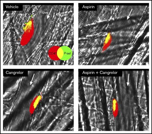 Figure 2. Dual antiplatelet treatment with aspirin and a P2Y12 antagonist is similar to treatment with either drug alone. Representative photomicrographs showing the response to laser-induced injury in mouse cremaster arterioles 3 minutes after injury. All platelets are labeled with anti-CD41 (red), and degranulated platelets are labeled with anti–P-selectin (green; overlay of red and green is yellow). The fluorescence channels were binarized and are displayed overlaid on the bright-field channel. The response to injury is shown for mice treated with vehicle, aspirin alone, cangrelor alone, or aspirin and cangrelor. Scale bar, 10 µm. Arrows indicate the direction of blood flow.