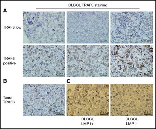 Figure 1. TRAF3 and LMP1 protein expression in human DLBCL samples. Formalin-fixed, paraffin-embedded tissue samples were stained for TRAF3 protein as described in “Methods.” (A) The top row shows representative samples identified by whole-exome sequencing as having decreased copy number for the TRAF3 gene stained for TRAF3 protein (brown); the bottom row shows representative samples identified as having a normal complement of TRAF3 genes stained for TRAF3 protein. (B) A control sample of normal human tonsil tissue stained for TRAF3 protein. (C) A sample with low/negative TRAF3 protein (previously determined by TRAF3 staining as in A) (left) stained in parallel for LMP1 (brown). An LMP1-negative specimen from the same tissue slide is shown on the right.
