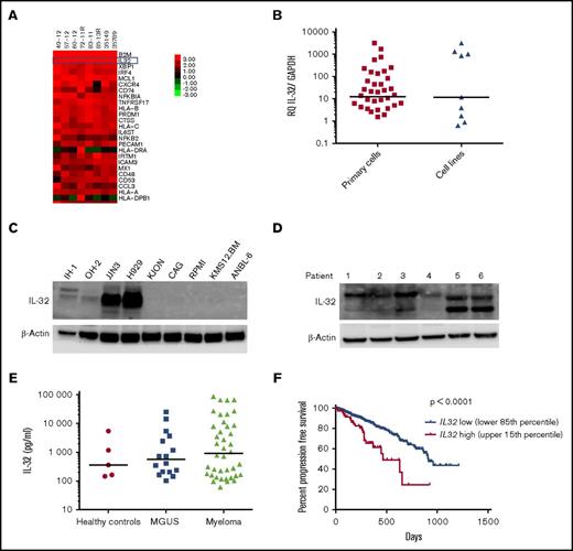Figure 1. IL-32 is expressed by MM cells, and high expression is correlated with inferior survival. (A) Heat map of top 25 most highly expressed genes as determined by Nanostring analyses in BM-derived CD138+ MM cells obtained from patients (n = 8). (B) IL32 mRNA expression was quantified by quantitative PCR in BM-derived CD138+ MM cells (n = 40) and MM cell lines (n = 9). Immunoblotting of total cell lysates from MM cell lines (n = 9) (C) and CD138+ primary MM cells (n = 6) (D). (E) IL-32 was quantified by ELISA in BM plasma obtained from healthy persons (n = 5; median, 360 pg/mL), patients with monoclonal gammopathy of unknown significance (MGUS; n = 16; median, 565.6 pg/mL), and patients with MM (n = 41; median, 906.5 pg/mL). The differences between the groups are not statistically significant. (F) Survival curves generated from the CoMMpass data (IA8 release) by comparing the IL32 upper 15th percentile (IL-32 expressors; n = 82; median survival, 464 days) with the lower 85th percentile (IL-32 nonexpressors; n = 466; median survival, 914 days). Log-rank P < .0001. Bars indicate median values in panels A and C.