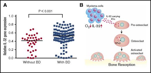 Figure 5. High IL-32 expression is associated with osteolytic bone disease. (A) IL32 gene expression in MM cells from patients without bone disease (BD; median, 0.42; n = 36) compared with patients with BD (median, 0.53; n = 137). Data obtained from GSE755. BD was defined as having ≥1 osteolytic lesion as assessed by magnetic resonance imaging. Mann-Whitney U test P < .001. (B) Summary of main findings presented in the article. In response to hypoxia, MM cells secrete IL-32 in EVs, which promote osteoclast differentiation.