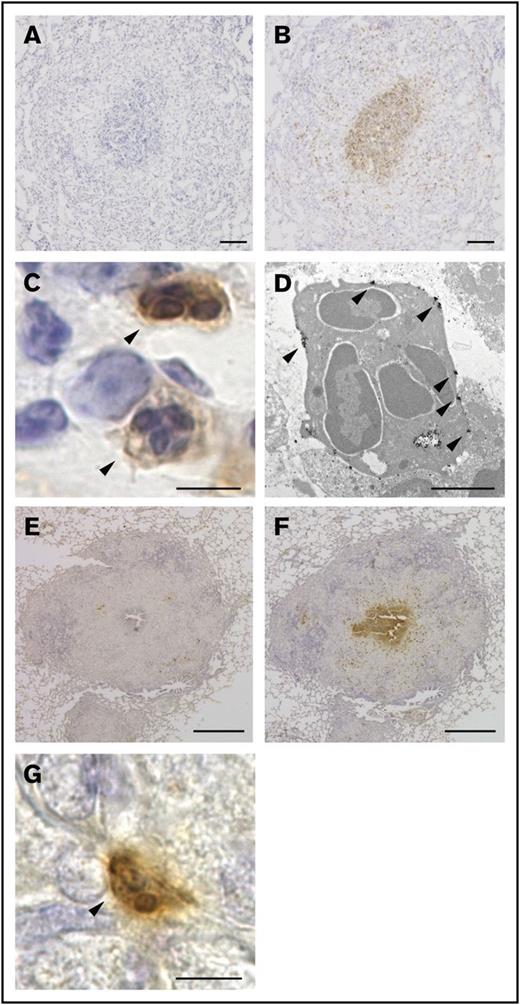 Figure 1. G213 reacted with PMNs located at the core of granulomas. (A-B) Sections of lungs obtained from the BCG-challenged guinea pig granuloma model were labeled with either isotype-matched negative control mAb (A) or G213 mAb (B), and HRP-DAB-based detection was performed. Sections were counterstained with hematoxylin. Scale bars, 100 μm. (C) A magnified view of G213-reactive cells (arrowheads) observed in panel B indicated that the stained cells were PMNs. Scale bar, 5 μm. (D) An immunoelectron micrograph of PMN cells positively labeled with G213 is shown. Gold particles representing the expression of the G213 antigen are indicated with arrowheads. Scale bar, 2 μm. (E-F) Paraffin-embedded lung sections derived from M tuberculosis–infected guinea pigs were labeled with either isotype-matched negative control mAb (E) or G213 mAb (F), and HRP-DAB-based detection was performed. G213-positive cells were prominently found in the central area of pathological granulomas. Scale bars, 1 mm. (G) A magnified view of a G213-positive cell (arrowhead) observed in panel F exhibited a typical PMN morphology. Scale bar, 5 μm.