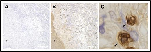 Figure 3. S100A9-expressing PMNs found in human pathological granulomas. (A-B) Sections of formalin-fixed, paraffin-embedded pathological lung tissues derived from patients with tuberculosis were labeled with either anti-human S100A9 (B) or control mAb (A), followed by HRP-DAB-based detection as described in “Methods.” Asterisks indicate the necrotic area at the center of the granuloma. Scale bars, 200 μm. (C) A magnified view of G213-reactive cells (arrowheads) observed in panel B indicated that the stained cells were PMNs. Scale bar, 5 μm.