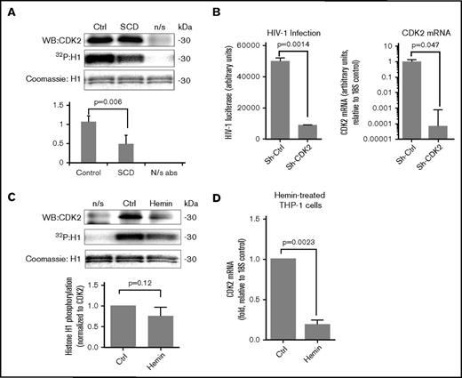 Figure 5. Reduction of CDK2 activity in SCD PBMCs. (A) CDK2 activity is reduced in SCD PBMCs. PBMCs were obtained from 3 SCD patients and 3 control subjects and activated with PHA and IL-2. Cells were lysed, and CDK2 was immunoprecipitated using anti-CDK2 antibodies from lysates that were equalized by protein. Kinase assays were performed using histone H1 as a substrate. Upper panels show a representative immunoblot of CDK2, a radioactive image of phosphorylated histone H1, and a Coomassie-stained image of histone H1. Lower panel shows quantification from 3 independent experiments. The means ± SD and P values calculated using Student t test are shown. (B) CDK2 knockdown inhibits HIV-1 infection in THP-1 cells. THP-1 cells were stably transduced with lentiviruses expressing CDK2-targeting shRNA or control shRNA and then infected with HIV-1-LUC-G virus. Left panel shows luciferase activity measured at 48 hours PI. Right panel shows expression of CDK2 mRNA determined by RT-PCR with 18S RNA as an internal reference for ΔΔCt analysis. The means ± SD are shown for 3 CDK2 KD and 3 control shRNA clones. (C) CDK2 activity is reduced in hemin-treated THP-1 cells. THP-1 cells treated with 75 μM hemin and control cells were lysed, and CDK2 was immunoprecipitated using anti-CDK2 antibodies. Kinase assays were performed using histone H1 as a substrate. Lower panel shows quantification from 3 independent experiments. P value was calculated using Student t test. (D) Hemin treatment reduces CDK2 mRNA expression. THP-1 cells were treated with 75 μM hemin for 24 hours. RNA was extracted, reverse transcribed, and analyzed by RT-PCR using primers for CDK2 and 18S rRNA as an internal reference for ΔΔCt analysis. The means ± SD and P values calculated using Student t test are shown for 3 independent samples. N/s abs, nonspecific antibodies.