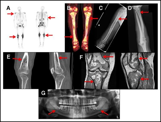 Figure 1. Bone lesions in ECD. The red arrows show: (A) Whole-body bone scan with technetium-99 showing avid uptake in the knees and left hip of an ECD patient. Less intense uptake occurs bilaterally in the humeri and distal tibias. (B) FDG PET-CT scan showing increased FDG uptake in the knees and proximal and distal tibias. (C) Bone radiograph showing cortical osteosclerosis in the right humeri. (D) Bone radiograph showing cortical osteosclerosis in the distal right radius. (E) CT scan of the right knee of an ECD patient showing cortical osteosclerosis and mottled appearance of the bone. (F) MRI scan of the right knee of an ECD patient showing serpiginous areas of T1 signal hypointensity, indicative of osteosclerosis. (G) Panoramic radiograph showing bilateral osteosclerosis of the mandible and maxillary sinus disease.