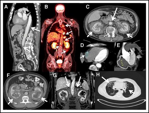 Figure 2. Cardiovascular, retroperitoneal, and lung images of ECD patients. (A) Sagittal reconstruction postcontrast CT demonstrates encasement of the thoracic aorta down to the bifurcation. (B) Coronal FDG PET-CT scan showing increased FDG uptake in the thoracic and abdominal aorta. Symmetrically encased kidneys “hairy kidney” showing increased FDG uptake. (C) Axial CT with contrast demonstrates mass-like enhancement encasing the kidneys symmetrically (“hairy kidney”). In addition, there is circumferential encasement and narrowing of the abdominal aorta (arrow). (D) Cardiac CT showing partial encasement of the right coronary artery. (E) Cardiac CT showing partial encasement of the right coronary artery. (F) Axial postcontrast CT image of the upper abdomen demonstrating mass-like perinephric stranding surrounding the kidneys with bilateral hydronephrosis. Hyperdense material within the right collecting system is a ureteral stent. (G) Postcontrast coronal MRI image of the kidneys demonstrating extension of the perinephric mass into the adrenal bed and encasement of the adrenals (arrows). (H) High-resolution CT of the chest showing interstitial fibrosis.