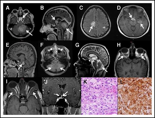 Figure 3. Brain images in ECD. (A) Axial post contrast brain MRI showing suprasellar and cerebellar involvement in a patient with ECD. (B) Sagittal post contrast brain MRI (from panel A) showing suprasellar and cerebellar tumors in a patient with ECD. (C) Axial fluid attenuated inversion recovery brain MRI showing ECD tumors in cerebral hemispheres. (D) Axial fluid attenuated inversion recovery brain MRI showing ECD tumors in cerebral hemisphere. (E) Sagittal post contrast brain MRI showing an ECD tumor with cystic components in the midbrain-pons of a patient with ECD. (F) T2 fluid attenuated inversion recovery MRI image showing increased symmetrical signal intensity in the cerebellum. (G) Neurodegeneration and atrophy of the cerebellum in a patient with ECD seen on brain MRI. (H) Orbital involvement with tissue accumulation in the intraconal space secondary to histiocytes accumulation in ECD. (I) Orbital involvement showing increased thickening of the lateral rectus muscle. (J) Pituitary stalk is thickened secondary to macrophage accumulation in ECD and deviated to the right. (K) Hematoxylin and eosin stain for brain lesion showing foamy macrophages and inflammation in brain mass biopsy specimen (original magnification ×40). (L) CD68 KP-1 stain of panel K highlighting the foamy macrophages (original magnification ×40).