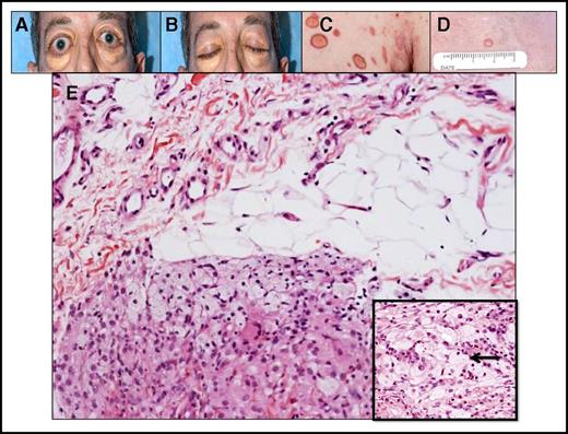 Figure 4. Skin findings in ECD. (A) Periorbital xanthelasmas in a patient with ECD. Note mild exophthalmos secondary to retro-orbital mass. (B) Upper lid xanthelasmas are apparent when the patient’s eyes are closed. (C) Skin lesions containing foamy macrophages negative for S-100 protein but with activating ALK gene fusion. (D) Skin lesion positive for BRAF V600E mutation. (E) Foamy macrophages in skin lesion. Inset shows lipid-laden macrophages interspersed with inflammatory cells (original magnification ×20; hematoxylin and eosin stain).