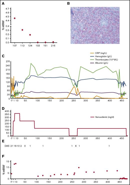 Figure 1. Effect of vemurafenib on disease and BRAF V600E levels. (A) Percentage of the BRAF V600E allele in the peripheral blood of patients at time of relapse (patient 107) or diagnosis (5 other patients). Patient 107 is the patient described in this case report; patients 113 and 134 had MS-LCH, patients 103 and 216 had multifocal bone LCH, and peripheral blood of patient 151 was used as a negative control (no BRAF V600E mutation in lesional cells). (B) Immunohistochemistry of a biopsy (gingiva) of patient 107 with an antibody against V600E. Original magnification ×40. (C) Monitoring of laboratory parameters under vemurafenib. (D) Vemurafenib dosage (milligrams per day) administered to the patient. (E) Disease activity score (DAS) during treatment with vemurafenib until HSCT (see also supplemental Table 1). (F) Percentage of circulating BRAF V600E alleles in the peripheral blood (whole blood) during therapy.