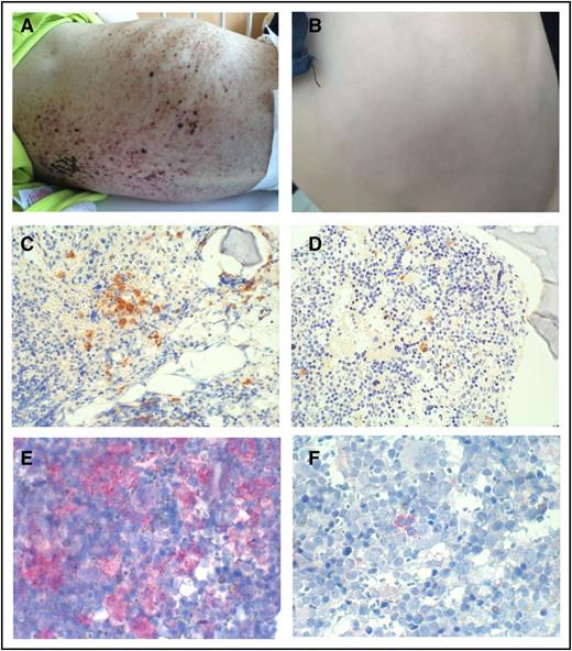 Figure 2. Effect of vemurafenib on skin lesions and bone marrow. Skin lesions at start of therapy with vemurafenib (A) and after 10 months of treatment with vemurafenib (B). Bone marrow biopsy stained with an antibody against CD1a before (C) and after 9 months (D) of treatment with vemurafenib. Expression of the mutated BRAF protein in the bone marrow before (E) and after 9 months (F) of treatment with vemurafenib. Original magnifications ×20 (C-D) and ×40 (E-F).