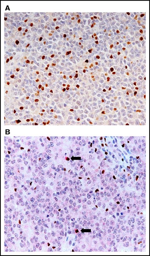 Figure 1. Histologic findings of LNs obtained from patients with DLBCL, NOS. (A) Increased infiltration of FOXP3-positive cells in the group of high levels of FOXP3-positive cells (immunostaining for FOXP3; objective magnification ×40). (B) Infiltration of FOXP3/CTLA-4 double-positive cells (arrows) in the group of high levels of FOXP3/CTLA-4 double-positive cells. FOXP3 stains the nuclei a brown color, and CTLA-4 stains the cytoplasm a red color (double immunostaining for FOXP3 and CTLA-4; objective magnification ×40).