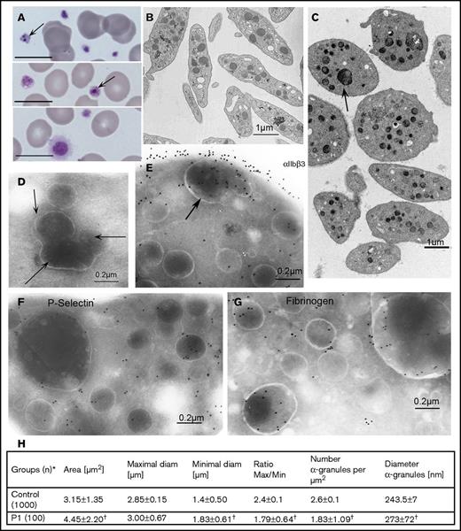 Figure 2. Morphologic evaluations of platelets from the proband (P1). (A) May-Grünwald-Giemsa–stained blood smears showing platelet anisotropy for P1 and abnormal granules (arrows). Scale bars represent 10 μm. (B-D) Typical electron microscopy (EM) images of platelets from (B) a control donor and (C) P1. The contrast between the discoid control platelets and the round enlarged platelets from P1 is striking; some contain many normal or 1 or more giant granules. (D-G) Selected immunogold labeling of cryosections of platelets from P1. All methods were as described in Nurden et al6 and involve incubation of sections with selected mAbs and their detection with a secondary antibody to murine IgG adsorbed on 10-nm gold particles. (D) A section without primary antibody; arrows indicate what appear to be grouped granules undergoing fusion or division. (E) αIIbβ3 (detected by using mAb AP-2) is shown on the platelet surface and within internal membrane systems, including those of an enlarged α-granule. (F) Similar labeling for P-selectin (mAb VH10). (G) Fibrinogen (Fg; with a polyclonal antibody) with gold beads often close to the α-granule membrane. For all immunogold images, scale bars represent 0.2 µm. (H) A quantitative morphometric evaluation of platelet size parameters (standard EM) and the number and diameter of α-granules of P1. *Number of platelet sections analyzed. Data are presented as mean ± standard deviation. Statistical significance was determined by Student t test for continuous variables. †A P value of < .01 was considered statistically significant.