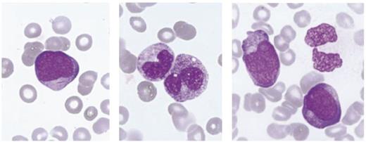 Y.Y. undertook intensive training in morphological assessment of blood and bone marrow, which is essential in identifying target cell populations and the interpretation of flow cytometry data.