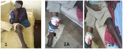 Undiagnosed patient with hemophilia, first case. The patient had his left leg amputated when hemarthropathy was misdiagnosed as joint TB or malignancy. Figure 2. Undiagnosed patient with hemophilia, second case.