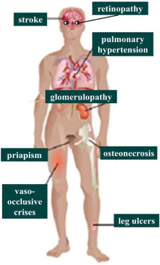 Figure 2. Vascular complications studied in the CADRE study.