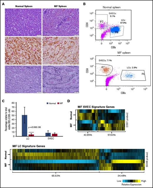 The properties of MF LCs and SVECs. (A, upper) Representative photomicrograph of hematoxylin and eosin staining of the red pulp of normal and MF spleens. Scale bar, 50 μm. (Middle) Matching samples stained with both anti-CD8α (brown) and anti-CD34 (magenta) antibodies. LCs are stained brown, SVECs are stained magenta. Scale bar, 20 μm. (Bottom) Reticulin staining of the matching samples as earlier. Scale bar, 50 μm. Pictures of all 3 panels were taken at 400× original magnification. (B) Representative FACS profiles of normal or MF nonhematopoietic cell fraction from collagenase digested nonsuspensive part of spleen tissues, which are CD45−CD3− and RBC-free. The percentages of LCs and SVECs are indicated in the profiles. (C) Percentage of normal or MF LCs and SVECs relative to total viable CD45−CD3−, RBC-free, nonhematopoietic splenic cells as in (B). Data are shown as mean ± SD, n > 3. ******P = 3.06E-06 by 2-sample Student t test. The result represents an average of 4 independent experiments with spleens from 4 patients with MF and 6 normal individuals. (D) The heat map of relative gene expression intensity for MF SVEC or LC gene signature. (Upper) MF SVECs; (lower) MF LCs. (E) DAVID Functional Annotation Clustering analysis of MF LC gene signature for downregulated genes in MF compared with normal LCs. (F) A network of energy production, nucleic acid metabolism, and small molecule biochemistry by IPA analysis of genes differentially expressed in MF compared with normal LCs. Network score, 27; focus molecules, 34; green, gene expression downregulated in MF LCs; red: gene expression upregulated in MF LCs; dotted arrow lines, direction of regulation. (G) z-scores of apoptosis, cell death, and necrosis by IPA disease or function analysis for MF LCs and SVECs compared with their normal counterparts. Activation z-score ≥2 predicts the increase of a function; ≤−2 predicts the decrease of a function. P value indicates the significance of an association with the change of a related function. (H) z-scores of cell movement, migration, and outgrowth of cells by IPA disease or function analysis for MF LCs and SVECs compared with their normal counterparts. MF LCs did not have any significant change with a qualified P value in these annotations. (I) DAVID Functional Annotation Clustering analysis of upregulated genes in MF SVECs compared with normal SVECs. (J) The heat map of relative average expression intensity for selected genes by normal or MF SVECs and LCs. (K) The number of colony forming units (CFUs) formed in the colony-forming assay after the cocultures of 3000 normal or MF splenic CD34+ cells with normal SVEC cell layers for 4 days (left graph) or 6 days (right graph). CD34+ cells of 1 MF and 2 normal spleens obtained from different individual donors were cocultured in parallel with each of the 2 lines of normal SVECs (#1 and #2). Each CD34+ cell coculture was plotted individually (blue, normal; red, MF). (L) The number of assayable CFUs after coculture of 3000 normal splenic CD34+ cells from 3 different donors each with 2 lines of normal or 1 line of MF SVECs for 4 to 6 days. IL1R1, interleukin 1 receptor type 1; NADH, nicotinamide adenine dinucleotide hydride.