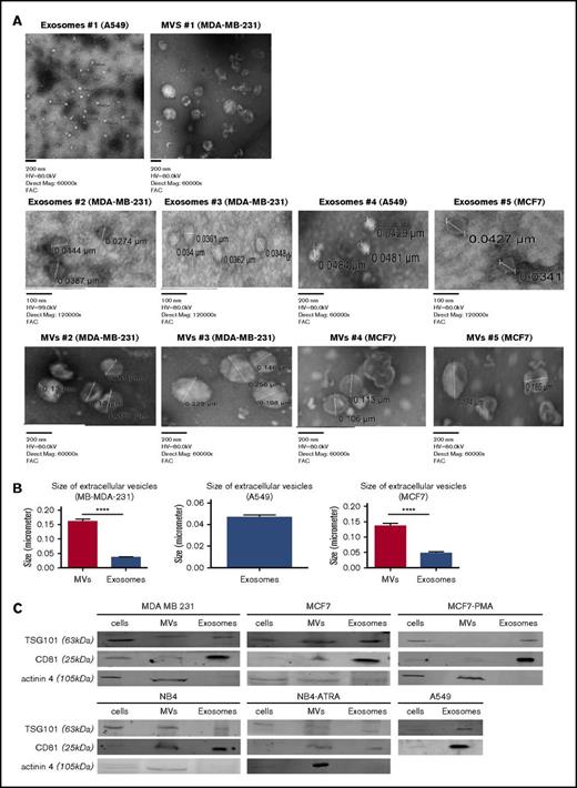 Figure 2. Characterization of exosomes and MVs from tumor cells. Exosomes and MVs, collected by differential centrifugation, were characterized by TEM (A) and western blot (C). The size of MVs was determined by TEM on 25 measurements from MB-MDA-231 cells and 25 measurements from MCF7 cells. (B) The size of exosomes was determined from 20 measurements from MD-MBA-231 cells, 15 measurements from MCF7 cells, and 15 measurements from A549 cells. Results are presented as mean ± SEM. (C) Cell lysates, exosomes, and MVs (30 μg) from each cell line were analyzed by western blotting for TSG101, CD81, and actinin-4. One representative blot is shown for each cell line. Each blot was repeated 3 times with different samples. ****P ≤ .0001, Mann-Whitney U test (1 tailed).