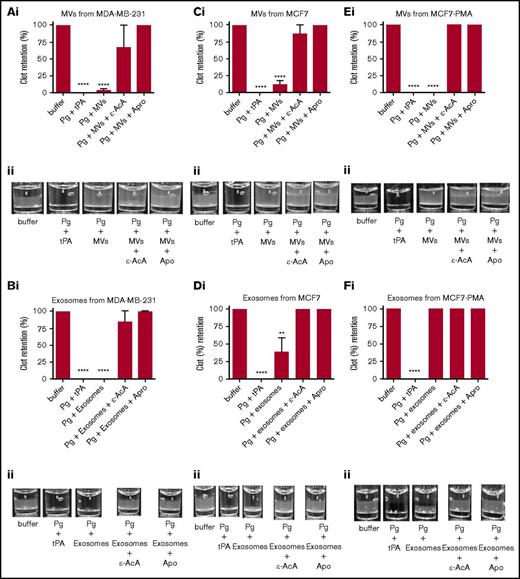 Fibrinolytic activity of exosomes and MVs from cancer cells on a fibrin clot. The analysis was performed on MDA-MB-231 cells (A-B), MCF7 cells (C-F), and NB4 cells (G-J) cell lines. Each experiment was repeated with 3 independent EV isolations. A fibrin clot was formed by the incubation of thrombin with pure fibrinogen. Exosomes and MVs (30 μg of protein) were added to the top of clot, followed by the addition of plasminogen (0.15 μM), with or without inhibitor (100 mM ε-AcA or 2.2 μM Apro). For a positive control, plasminogen (0.15 μM) and tPA (25 nM) were added to the fibrin clot. OD was measured at 350 nm every 20 minutes for 18 hours at 37°C. Results are represented as the mean ± SEM (n = 3 independent samples). The percentage of clot retention is shown for MVs (Ai) and exosomes (Bi) from MDA-MB-231 cells, MVs (Ci) and exosomes (Di) from MCF7 cells, MVs (Ei) and exosomes (Fi) from MCF7-PMA cells, MVs (Gi) and exosomes (Hi) from NB4 cells, and MVs (Ii) and exosomes (Ji) from NB4-ATRA cells. A representative photograph of the experiment is shown for MVs (Aii) and exosomes (Bii) from MDA-MB-231 cells, MVs (Cii) and exosomes (Dii) from MCF7 cells, MVs (Eii) and exosomes (Fii) from MCF7-PMA cells, MVs (Gii) and exosomes (Hii) from NB4 cells, and MVs (Iii) and exosomes (Jii) from NB4-ATRA cells. *P ≤ .05, **P ≤ .01, ****P ≤ .0001, Mann-Whitney U test (1 tailed).