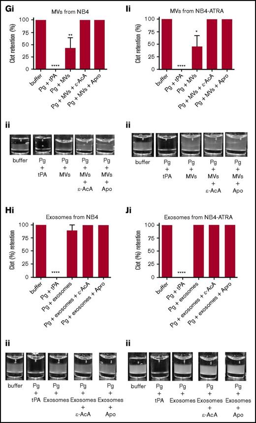 Fibrinolytic activity of exosomes and MVs from cancer cells on a fibrin clot. The analysis was performed on MDA-MB-231 cells (A-B), MCF7 cells (C-F), and NB4 cells (G-J) cell lines. Each experiment was repeated with 3 independent EV isolations. A fibrin clot was formed by the incubation of thrombin with pure fibrinogen. Exosomes and MVs (30 μg of protein) were added to the top of clot, followed by the addition of plasminogen (0.15 μM), with or without inhibitor (100 mM ε-AcA or 2.2 μM Apro). For a positive control, plasminogen (0.15 μM) and tPA (25 nM) were added to the fibrin clot. OD was measured at 350 nm every 20 minutes for 18 hours at 37°C. Results are represented as the mean ± SEM (n = 3 independent samples). The percentage of clot retention is shown for MVs (Ai) and exosomes (Bi) from MDA-MB-231 cells, MVs (Ci) and exosomes (Di) from MCF7 cells, MVs (Ei) and exosomes (Fi) from MCF7-PMA cells, MVs (Gi) and exosomes (Hi) from NB4 cells, and MVs (Ii) and exosomes (Ji) from NB4-ATRA cells. A representative photograph of the experiment is shown for MVs (Aii) and exosomes (Bii) from MDA-MB-231 cells, MVs (Cii) and exosomes (Dii) from MCF7 cells, MVs (Eii) and exosomes (Fii) from MCF7-PMA cells, MVs (Gii) and exosomes (Hii) from NB4 cells, and MVs (Iii) and exosomes (Jii) from NB4-ATRA cells. *P ≤ .05, **P ≤ .01, ****P ≤ .0001, Mann-Whitney U test (1 tailed).