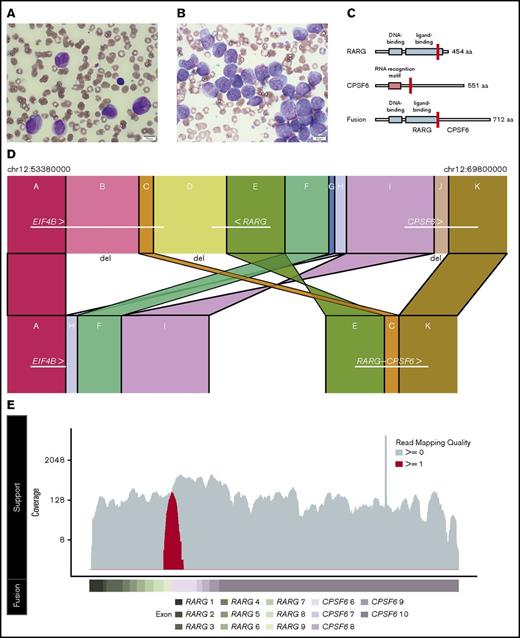 Figure 1. Histopathologic and genomic characterization of a case of AML with promyelocytic features. (A) Wright-Giemsa staining of the peripheral blood smear highlighting promyelocytes (original magnification ×100). (B) Wright-Giemsa staining of the aspirate from the diagnostic bone marrow biopsy highlighting numerous blasts and promyelocytes (original magnification ×100). The images were captured by an Olympus BX53 microscope with an Olympus UPlanSApo 100×/1.4 oil objective and an Olympus DP26 digital camera with Olympus cellSens standard software (version 1.16; Tokyo, Japan). (C) Representative schematic of the main protein domains of RARG isoform 1 (top), CSPF6 isoform 2 (middle), and the predicted RARG-CPSF6 fusion (bottom) with the fusion breakpoints highlighted in red (for RARG at amino acid 392 and for CPSF6 at amino acid 231). Isoform choice was based on read support from the RNA-Seq data. (D) Schematic of the highly rearranged region on chromosome 12 where the reciprocal inversion occurred. In panel D, regions A and K bookend regions B-J that were involved in distinct deletions or rearrangement events. The segments are not to scale. (E) RNA-Seq reads based on a pseudo-alignment to the RARG-CPSF6 predicted fusion transcript. The coverage of reads uniquely aligned to the predicted fusion (spanning the fusion breakpoint) is displayed in red on the top track in relation to the exons for the predicted fusion (bottom track). We observed only three reads supporting wild-type RARG expression, which are likely indicative of a small number of contaminating benign cells.