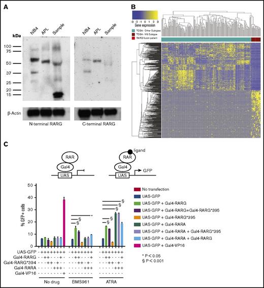Figure 2. Protein analysis and functional characterization of the RARG-CPSF6 gene fusion. (A) N-terminal and C-terminal anti-RARG antibodies were used to probe immunoblots prepared from NB4 cells (an APL cell line), a t(15;17) APL sample, and a sample from our patient. Both experiments were repeated independently with similar results. (B) Supervised hierarchical clustering of the top 500 dysregulated genes in t(15;17) APL (compared to all of the other non-t(15;17) AML cases included in the TCGA AML analysis) clusters the case (bright red) with other APLs (dark red). (C) A schematic of the experimental platform (top). The Gal4-RARG*395 truncation did not activate the UAS-GFP reporter when treated with either ATRA or BMS961 (a RARG agonist). Gal4-RARG and Gal4-RARA both activated the UAS-GFP reporter in response to ATRA, and this was not inhibited by coexpression of Gal4-RARG*395, indicating that the truncated RARG did not act as a dominant-negative against RARA or RARG in this assay (* and § P values calculated by ANOVA with Bonferroni correction for multiple comparisons). This experiment was repeated independently with similar results.
