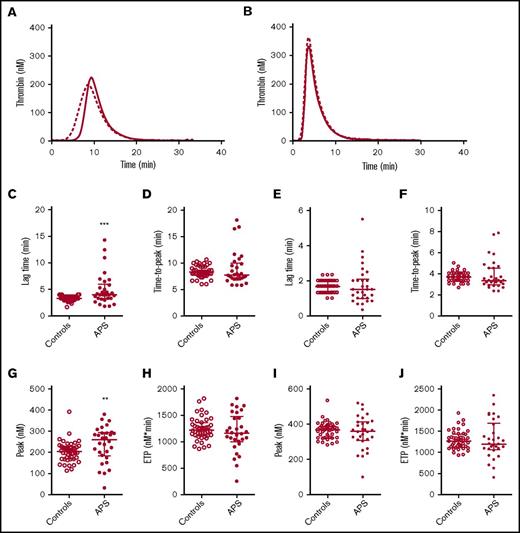 Figure 1. TG in APS patients and controls. Average TG curves are shown for healthy controls (dashed line) and APS patients (continuous line) at 1 (A) and 5 (B) pM TF. TG parameters lag time (C,E), time-to-peak (D,F), peak height (G,I), and ETP (H,J) were quantified for 1 and 5 pM TG curves, respectively. ***P < .001, **P < .01 according to a 2-sided Mann-Whitney U test.