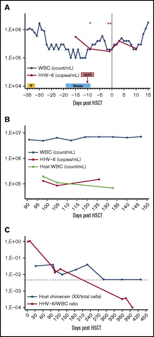 Figure 1. Association between HHV-6 viral load, WBC, and host chimerism at various time points before and after HSCT. (A) Pre- and early posttransplant until donor engraftment (when all circulating cells were of host origin), the HHV-6 viral load (copies per mL) was approximately equal to WBC (count per mL), except for the initial episode of HHV-6 viremia (day −15) after reinduction with a vorinostat (V)–containing regimen. Presence of ciHHV-6 in the host was confirmed with a ratio-based PCR on 2 separated time points (days −9 and −1), with an HHV-6 viral copies per cell genome ratio of ∼1, indicating that the source of HHV-6 viremia was circulating host cells with ciHHV-6. The only exception was day −15 when HHV-6 viral load (copies per mL) >> WBC (count per mL) in combination with fever and rash, suggesting presence of HHV-6 reactivation from ciHHV-6 state, possibly induced by exposure to a histone deacetylase (HDAC) inhibitor. (Results of ratio-based PCR assay for the detection of ciHHV-6: *1.12, **0.9.) (B) After donor engraftment and before full donor chimerism was achieved, the HHV-6 viral load (copies per mL) was much lower than WBC (count per mL). We reasoned that the donor did not have ciHHV-6 and that circulating nucleated cells of host origin with ciHHV-6 were the source of ongoing HHV-6 viremia during this time. Indeed, we observed that host WBC count (count per mL), which was calculated by multiplying PB host chimerism as measured by interphase FISH by the total WBC count obtained from same-day hemograms, approximated the HHV-6 viral load (copies per mL). (C) The calculated HHV-6 viral load to total WBC ratio can be used to estimate persistent host chimerism when the HSCT recipient, but not donor, has ciHHV-6. In the late posttransplant period, the HHV-6 viral load to WBC count ratio had greater sensitivity for the detection of host microchimerism compared with interphase FISH. Specifically, because the sensitivity of the FISH chimerism assay depends on the number of cells analyzed, 1 to 2 log more cells would have been needed to detect host microchimerism at that time. (The horizontal interrupted line represents the detection limit of 200-cell interphase FISH assay.)