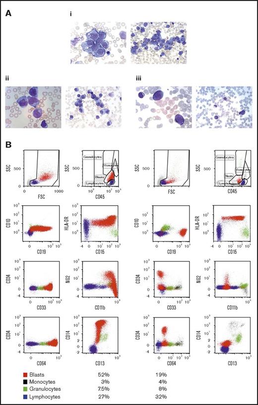 Figure 1. Phenotypic evolution of leukemic blasts after blinatumomab treatment. (A) L1/2 morphology of blasts (bone marrow) at the time of relapse, before blinatumomab (i); myelomonocytic morphology of cells in the bone marrow 11 days after blinatumomab treatment (ii) and 9 days after cessation of blinatumomab (iii). In each image pair, magnification is 1:1000 (left) and 1:500 (right) (Pappenheim staining). (B) Flow cytometry at the 2 respective time points: directly after blinatumomab treatment (left 2 columns) and 9 days later (right 2 columns). Staining shows CD45+ live cells.