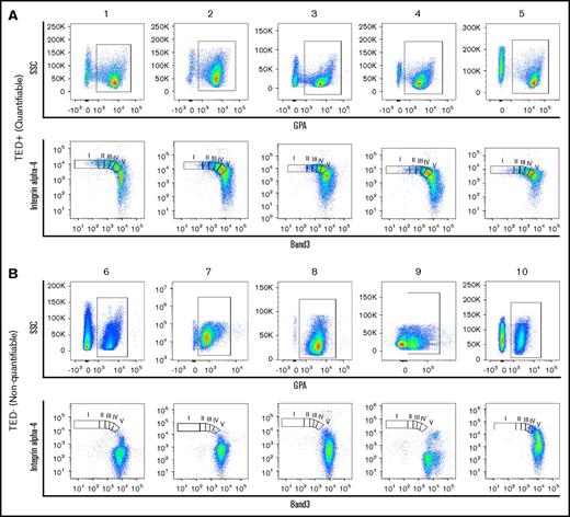 Figure 1. Flow cytometry profiles of patient samples. Representative dot plots of TED profiles, as observed on flow cytometry, obtained from primary human BM of MDS samples from (A) 5 quantifiable samples and (B) 5 nonquantifiable samples. GPA+ cells (A-B, top) were found in both quantifiable and nonquantifiable samples, but the nonquantifiable samples were characterized by (B, top) low GPA expression and (B, bottom) absence of cells undergoing TED. I, II, III, IV, V, represent pro, EB, LB, poly, ortho stages of TED; SSC, side scatter.