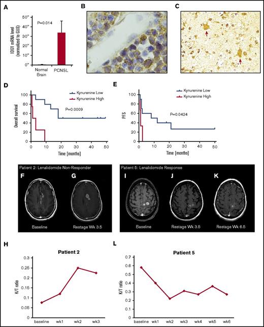 Figure 3. Expression of IDO1 in PCNSL and IDO activity and response to lenalidomide in relapsed CNS lymphoma. (A) Quantitative reverse transcription polymerase chain reaction demonstrated increased expression of IDO1 transcripts in 10 cases of PCNSL (DLBCL) compared with 3 cases of nonneoplastic brain (P < .014, Wilcoxon test). Immunohistochemistry using α-IDO-1 antibody (Abcam clone 55305, with diaminobenzidine detection, hematoxylin counterstain) demonstrated IDO-1 expression in 19/20 cases of newly diagnosed PCNSL (supplemental Table 4). In 12 of these, IDO1 immunoreactivity was exhibited by (B, ×1000 >40% of lymphoma cells) and (C, ×400) tumor-associated macrophages. These displayed dendritic morphology and coexpressed CD163, a marker of alternative activation (not shown). Elevated baseline CSF kynurenine concentration (1.5 μM) correlated with shorter overall survival among the 14 phase 1 trial subjects as well as shorter progression-free survival with lenalidomide. (D-E) We also detected increasing CSF kynurenine/tryptophan ratios in 3 patients who had low CSF kynurenine at baseline and in whom CSF kynurenine levels exceeded the high-risk benchmark of 1.5 μM at tumor progression. Serial quantification of the K/T ratio in CSF in lenalidomide/rituximab trial subjects demonstrated that changes in IDO activity correlated with early progression and/or response to lenalidomide in 10 of 13 evaluable patients. Representative examples are shown: axial-T1 postgadolinium MRI scan demonstrating CNS lymphoma progression during first month of lenalidomide in patient 2: pretreatment (F) at baseline and (G) 1 month. The CSF K/T ratio at 1 month increased by nearly threefold compared with baseline during this interval. (H) MRI scan showing progressive regression of CNS lymphoma in response to lenalidomide monotherapy in patient 5: pretreatment (I) at baseline, (J) at 1 month, and (K) 2 months. (L) The CSF K/T ratio declined by >50% during the first 2 months of lenalidomide therapy in this patient. mRNA, messenger RNA.