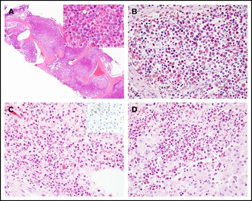 Figure 1. Histology of hypereosinophilic syndrome in AML. (A) Marked eosinophilia in the bone marrow at the last relapse (original magnification ×40; inset ×400; hematoxylin and eosin stain). Eosinophilic infiltrate in (B) lymph node, (C) adrenal medulla (inset: CD34 immunostain), and (D) liver at autopsy. Original magnification by ×400, hematoxylin and eosin stain, except as noted.