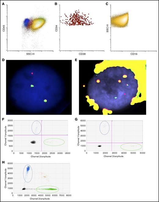 Figure 2. Detection of KRASG12D mutation and inv(16) in sorted blasts and eosinophils. (A) Dot plot of bone marrow cells (yellow: eosinophils; red: blasts; blue: lymphocytes; pink: monocytes; green: neutrophils). (B) Sorted blasts (CD45dimCD34+CD15−CD117+SSClo). (C) Sorted eosinophils (CD45+CD34−CD117−CD15+SSChi). FISH studies using CBFB break-apart probes (Abbott Molecular, Des Plaines, IL) showing a split signal pattern of CBFB probes (ie, inv(16)), in (D) sorted blasts and in (E) eosinophils. Detection of KRASG12D in (F) sorted blasts, (G) eosinophils, and (H) FFPE adrenal tissue by ddPCR. Blue dots represent mutant droplets; green dots represent wild-type droplets, and red or gray dots represent empty droplets. SSC-H, side-scatter height.