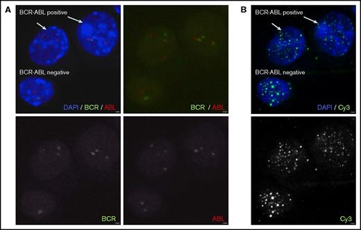 Figure 1. Representative laser scanning confocal microscopy images obtained after applying a 2-phase combined FISH technique based on coordinate assembly protocol for assessment of TL within the same CP CML patient’s CD34+38− compartment. (A) In phase 1, BCR-ABL+ and BCR-ABL− cells were identified by BCR-ABL FISH staining. (B) In phase 2, PNA-Tel Q-FISH is used to restain the samples allowing telomere quantification in the BCR-ABL+ and BCR-ABL− cells within the same individual’s CD34+38− compartment. Image magnification ×630. Digital zoom ×2.5. DAPI, 4′,6-diamidino-2-phenylindole.