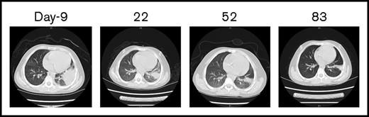 Figure 3. CT scans of the chest before and after allo–/auto–CAR-T infusions. Before CAR-T treatment, CT scans revealed severe infections (day −9), which gradually resolved after allo– and auto–CAR-T infusions (days 22, 52, and 83).