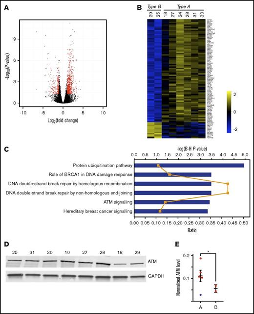 Figure 3. Significant differences in translational efficiencies of DNA damage repair pathway genes between patient clusters. (A) Volcano plot showing the results of the Xtail analysis. Genes highlighted in red are those with a fold change of at least 2, and an adjusted P < .05. The final list of 748 changing genes discards genes with low raw read counts (supplemental Table 4; “Materials and methods”). (B) Heat map showing the log2 TE values for the 88 genes listed in Figure 4. (C) The 748 genes that are differentially translated between type A and type B were subjected to a function and pathway enrichment analysis using Qiagen’s Ingenuity Pathway Analysis tool (IPA). Plot shows enriched canonical pathways at adjusted P < .001 (−log(Benjamini-Hochberg P value) shown as blue bars), with ratio (the proportion of the genes in the pathway that are also found in our list) shown as orange line. There are some pathways in this plot that do not appear relevant to the functioning of B lymphocytes. Their presence is explained by the reuse of the same signaling proteins in various pathways in different cell lineages. (D) Western blot analysis of ATM protein expression for 8 samples (10, 18, 25, 27, 28, 29, 30, and 31) subjected to ribosome profiling. No material was available for samples 22 and 24. (E) Normalized ATM levels (ATM fluorescence signal to GAPDH fluorescence signal) is shown for type A and type B patients. Error bars show mean ± SEM. Sample 18 (blue dot) in type A patients, was found to bear an ATM mutation (supplemental Table 1) and was excluded from the statistical analysis. Normalized ATM levels are significantly higher in type A than type B (unpaired 2-tailed Student t test, *P = .02).