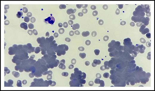 Figure 1. Peripheral blood smear. Hematoxylin and eosin stain of peripheral blood smear (original magnification ×100) shows anisocytosis, rouleaux and agglutination formation, few hypochromic red blood cells, microspherocytes and nucleated red blood cells, scattered platelet clumping, and moderate to severe neutropenia.