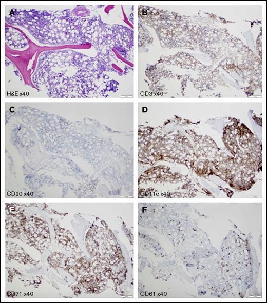 Figure 2. Bone marrow biopsy. (A) Hematoxylin and eosin stain shows hypercellular for the age (80%-90%) bone marrow with increased elements of all 3 lineages. Reticulin stain shows no bone marrow fibrosis (data not shown). Anti-CD3 (B) and anti-CD20 (C) antibodies show scattered small T cells and B cells, respectively; no clusters of B cells and no large B cells are detected. (D) Anti-CD11c antibody represents increased myeloid elements. (E) Anti-CD71 antibody highlights increased erythroid elements. (F) Anti-CD61 antibody demonstrates markedly increased left-shifted megakaryocytes; no atypical megakaryocytes or megakaryocyte clustering is detected. Scale bars, 200 μm.
