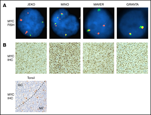 MYC DNA is structurally abnormal and MYC protein is overexpressed in MCL cells. (A) FISH was conducted using directly labeled dual-color break-apart Vysis MYC probes (5′ labeled in spectrum orange and 3′ in spectrum green), and images were captured using the Zeiss Axio Imager.Z2 Microscope with CytoVision Software. Magnification ×1000. (B) IHC staining in cell blocks from the 4 MCL cell lines and tonsil (bottom) as control. Moderately strong nuclear staining is seen in all 4 cell lines. In tonsil, most of small lymphoid cells including lymphocytes in mantle zone (MZ) and paracortical T-cell areas stain negative for MYC. Occasional large proliferative cells stain positive and are scattered within or outside the germinal centers (GC). The pattern is expected and shows specificity of the MYC immune stain. The dotted line denotes the border between the GC and the MZ. Magnification ×200.