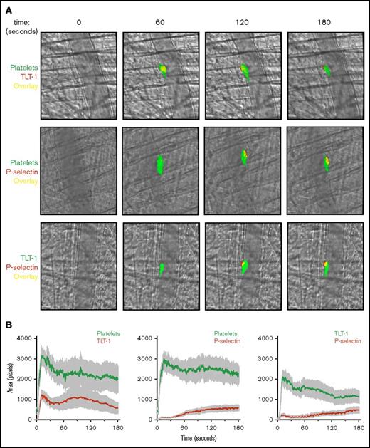 TLT-1 appears more rapidly and is detected throughout laser-induced thrombi in vivo. Mice were injected with anti-GPIbβ, anti-TLT-1, or anti-CD62P antibody. Arterioles of cremaster muscles were subsequently injured by laser. (A) Representative composite bright-field and fluorescence images of platelets (GPIbβ), TLT-1, and P-selectin in thrombi. Scale bars, 10 µm. (B) Quantification of fluorescence area in pixels (data represent mean ± standard error of the mean; n = 25-32 injuries from 4 to 6 mice). (C) Distinct and overlapping staining of TLT-1 and P-selectin in platelets and megakaryocytes. Resting human (top row) and mouse (middle row) platelets seeded on poly-l-lysine and primary mouse BM-derived megakaryocytes (MK) (bottom row) spread on fibrinogen matrix for 15 minutes at 37°C were fixed, permeabilized, and stained with Alexa Fluor 488 anti-TLT-1 and Alexa Fluor 647 anti-P-selectin antibodies. The right column represented an overlay of both images. Scale bars, 5 µm. Images are representative of 3 to 4 independent experiments. (D) Degree of TLT-1 and P-selectin colocalization as determined by the Manders overlap coefficients (M1: TLT-1:P-selectin and M2: P-selectin:TLT-1) in resting human (i) and mouse platelets (ii), and object-based colocalization in mouse BM-derived megakaryocytes (iii) (n = 3-4 independent experiments per condition, 400-600 platelets, and 25-35 megakaryocytes per experiment).