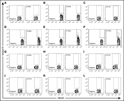 Figure 6. UNC-GRK4-V–specific T cells are present post-SCT. UNC-GRK4-V–specific T-cell populations were tested in 12 HLA-A*02:01–expressing AML patients who had undergone allo-SCT. Negative tetramers were used for each sample to define tetramer-positive gates for each patient. (A-C) Three patients in DRPs with gMMs for UNC-GRK4-V were tested, with 1 patient (A, alive 29 months post-SCT with chronic GVHD) showing an expanded tetramer-positive population. (D-I) Six patients in DRPs where both the recipient and donor carried the UNC-GRK4-V allele were tested, and 3 patients (D, alive 75 months post-SCT with mild chronic GVHD; E, died of relapsed AML 21 months post-SCT; F, alive 84 months post-SCT without GVHD) showed evidence of a tetramer-positive population. (J-L) Three patients in DRPs in which the patient did not carry the UNC-GRK4-V allele were tested, and no samples showed a tetramer-positive population.
