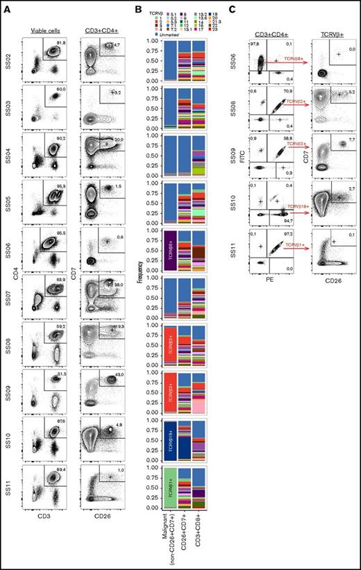 Figure 1. Identification of the malignant population. (A) Gating strategy of nonmalignant CD3+CD4+CD7+CD26+ cells from 10 patients with SS (SS2-SS11). (B) TCRVβ distribution within the CD4+ non-CD26+CD7+ (malignant), CD4+CD26+CD7+ (nonmalignant), and CD8+ T cell populations. Because of incomplete antibody coverage by the TCRVβ screening kit, not all T cells can be assigned to a TCRVβ and are included in the “unmarked” fraction. (C) Assessment of the fraction of CD26+CD7+ cells within the CD4+ population expressing the dominant TCRVβ clone detected in 5 of the 10 patients with SS.