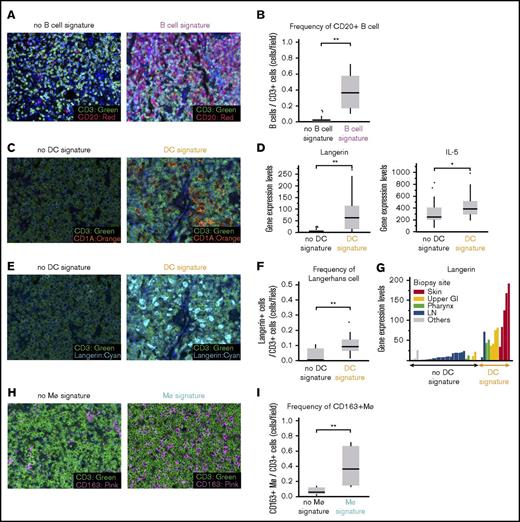 Figure 2. PTCL-NOS tissues harbor microenvironmental immune cells. (A) Representative images of FFPE sections costained with fluorochrome-conjugated anti-CD20 (red) and -CD3 (green) antibodies. Immunofluorescence; original magnification ×20. CD20+ B cells were evident in the B-cell-signature–rich case (right) but not in a case lacking that signature (left). (B) Numbers of CD20+ cells and CD3+ cells were counted across sections using scanning software (see “Methods”). Frequencies of CD20+ cells relative to CD3+ cells are shown. **P < .01 (Wilcoxon rank-sum test). (C) Tumor sections were stained with anti-CD1A (orange), a DC marker, and anti-CD3 (green). Representative DC signature–rich (right) and –poor (left) cases are shown. Immunofluorescence; original magnification ×20. (D) Box-and-whisker plots represent Langerin (left) and IL-15 (right) mRNA levels in cases with or without the DC signature. *P < .05, **P < .01 (Wilcoxon rank-sum test). (E) IF was performed using antibodies against Langerin (cyan), a Langerhans cell marker, and CD3 (green), a T-cell marker. Representative images are shown. Immunofluorescence; original magnification ×20. Langerin expression was evident only in DC signature–rich cases (right). (F) Box-and-whisker plots represent frequencies of DCs as described in panel B. **P < .01 (Wilcoxon rank-sum test). (G) Bar graph shows Langerin mRNA levels in samples obtained from indicated biopsy sites. (H) IF was performed using antibodies against CD163 (pink), a macrophage marker, and CD3 (green). Representative images are shown. Immunofluorescence; original magnification ×20. (I) Frequencies of CD163+ macrophages relative to CD3+ cells are shown. **P < .01 (Wilcoxon rank-sum test).