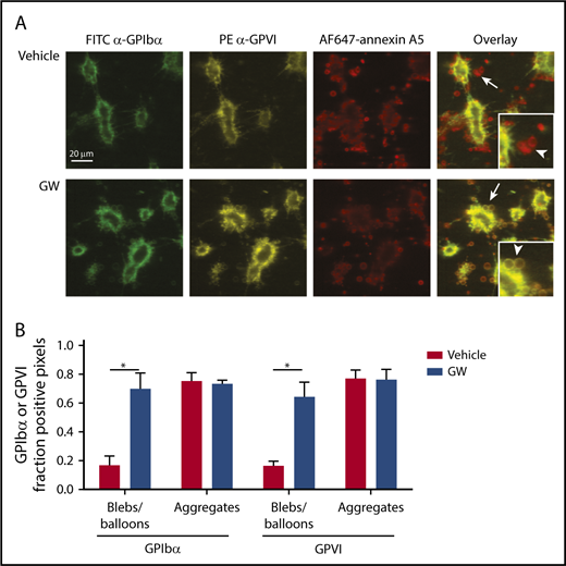 Figure 6. Selective loss of GPIbα and GPVI in high-Ca2+ PS-exposing platelets in thrombi. Platelet thrombi were formed in flow chambers on collagen type I using whole-blood perfusion at a wall shear rate of 1000 s−1. The thrombi were postactivated with thrombin, incubated with vehicle or GW280264X (GW) for up to 180 minutes at 37°C, and stained for GPIbα and GPVI expression and PS exposure. (A) Representative confocal fluorescence images of GPIbα and GPVI expression and PS exposure. PS-exposing ballooned platelets are indicated by arrows and arrowheads. (B) Regions of interest corresponding to aggregated platelets and ballooned platelets were analyzed for fluorescence staining. Pixels representing GPIbα− or GPVI+ platelets were determined and expressed as percentages of surface area coverage of ballooned or aggregated platelets. Data are mean ± SD, n = 3. *P < .05.