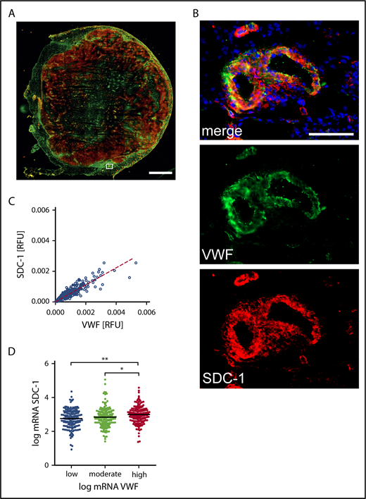 Figure 3. Coexpression of SDC-1 and VWF in melanoma tissue. (A) Representative overview image of a tumor tissue section comprising the primary melanoma and adjacent peritumoral skin. The image was assembled from 156 single immune fluorescence images. Scale bar, 2 mm. The white box marks a skin blood vessel adjacent to the melanoma tissue. The corresponding magnification is depicted in panel B. VWF is shown in green, SDC-1 in red, and cell nuclei in blue. Scale bar, 100 µm. (C) Colocalization of SDC-1 and VWF was quantified in 1649 blood vessels. The dashed line indicates the linear correlation between the expression of VWF and SDC-1. R2 = 0.87; P < .0001 (Spearman’s rank correlation). (D) Transcription analysis confirms correlation of SDC-1 and VWF expression in primary tumors of 479 patients with malignant melanoma. *P ≤ .05, **P ≤ .01 (1-way analysis of variance and Bonferroni post hoc test). mRNA, messenger RNA; RFU, relative fluorescence unit.
