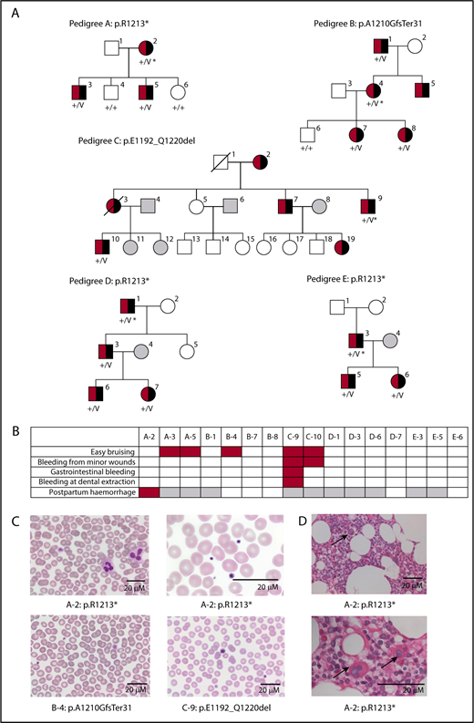 Figure 1. Variants in DIAPH1 associated with D-RD. (A) Pedigree diagrams demonstrating cosegregation of the DIAPH1 variants with sensorineural hearing impairment (black shading) and hematological abnormalities (red shading) in 5 pedigrees. The open symbols indicate unaffected pedigree members. The gray symbols indicate pedigree members with no data available. *Index cases. (B) Annotation of the 16 D-RD cases with Human Phenotype Ontology terms for bleeding symptoms. Red shading indicates the presence of the bleeding symptom. Gray shading indicates that a symptom was not applicable due to patient age or sex. (C) Representative May-Grünwald-Giemsa–stained peripheral blood smears from D-RD cases A-2, B-4, and C-9 representing each of the 3 observed DIAPH1 variants. Original magnification ×40. (D) Hematoxylin and eosin–stained bone marrow biopsy from D-RD case A-2 (R1213*). Granulopoiesis was reduced, with few examples of mature neutrophils. MKs were normal in number but generally small, with hypolobated nuclei (arrows). Original magnification ×100. V, variant DIAPH1 alleles; +, wild-type DIAPH1 alleles.