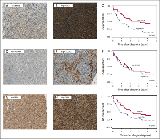 Figure 3. Immunohistochemical evaluation of putative predictive markers and outcome in PTCL-NOS patients. Representative images showing high and low expression of ENO1 (A-B), ALDH2 (D-E), and TPI1 (G-H) by IHC are shown in PTCL-NOS tissue. OS curves for the patients according to marker expression (C,F,I).Original magnification ×10.