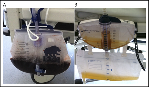Figure 3. Eculizumab response in a patient with an acute CAS. Urine of patient 5 with severe intravascular hemolysis and hemoglobinuria immediately before (A) and 24 hours after (B) the first dose of eculizumab.