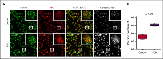 Figure 2. NLRP3 and ASC colocalize in platelets derived from SCD patients. (A) In platelets derived from SCD patients in steady state, intraplatelet ASC (red) colocalizes with NLRP3 (green), as demonstrated with immunofluorescence staining and confocal laser scanning microscopy. Images show maximum intensity projection of confocal images Z-stacks and are representative of 3 independent preparations per group. Scale bar, 2 μm. (B) Quantification of NLRP3/ASC colocalization using the Pearson correlation coefficient. Data are shown as median with IQR and minimum and maximum values from n = 3 subjects per group. The P value was calculated using the Mann-Whitney U test.